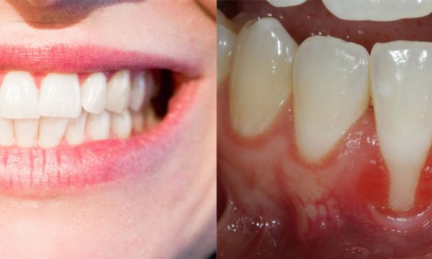 La greffe gingivale : plus qu’une chirurgie réparatrice
