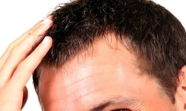 La greffe de cheveux : une technique efficace pour lutter contre la calvitie